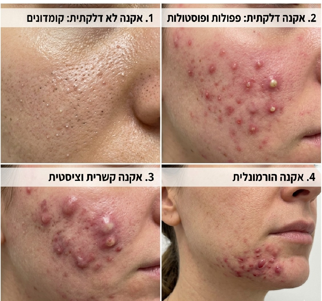 סוגי אקנה: קומדונים, פפולות, אקנה קשרית וציסטית, אקנה הורמונלי — Beauty Ziv
